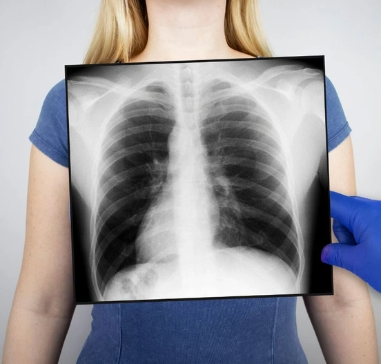 Chụp X-quang phổi