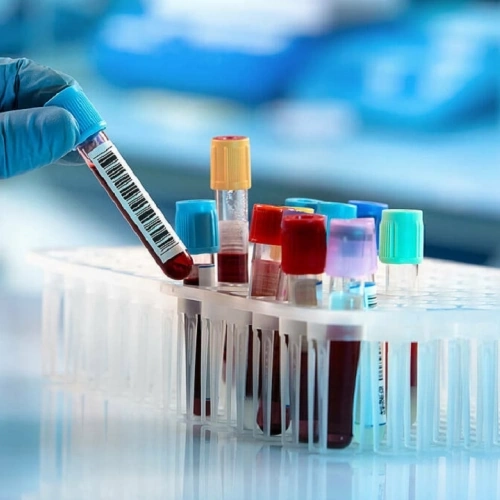 Tổng phân tích tế bào máu ngoại vi: