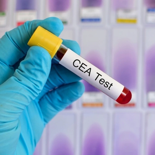 Xét nghiệm định lượng CEA (Carcino Embryonic Antigen)
