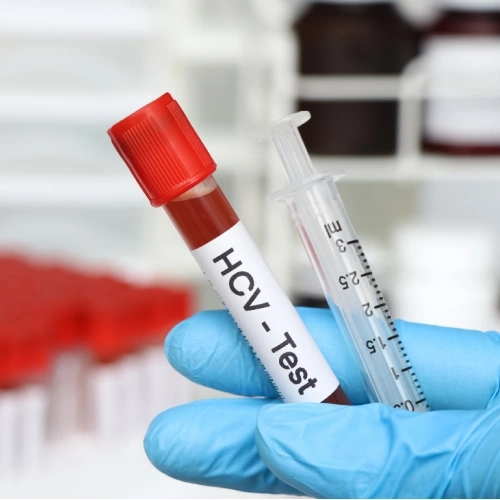 HCV Ab miễn dịch tự động