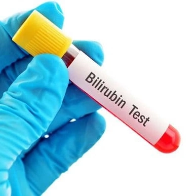 Định lượng Bilirubin trực tiếp và gián tiếp