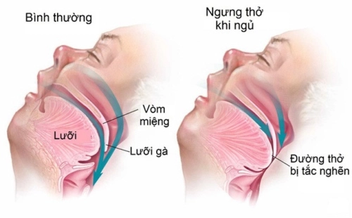 Những điều cần biết về hội chứng ngưng thở tắc nghẽn khi ngủ