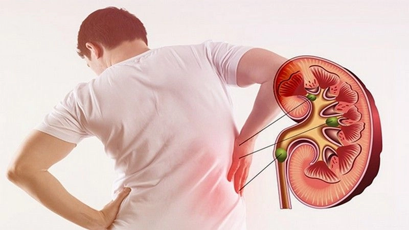 Sỏi thận là gì? Dấu Hiệu Triệu Chứng, Nguyên Nhân Và Điều Trị 