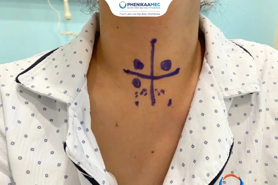 Triệt căn 6 nhân ung thư tuyến giáp trong một ca mổ, tối ưu thẩm mỹ cho người bệnh