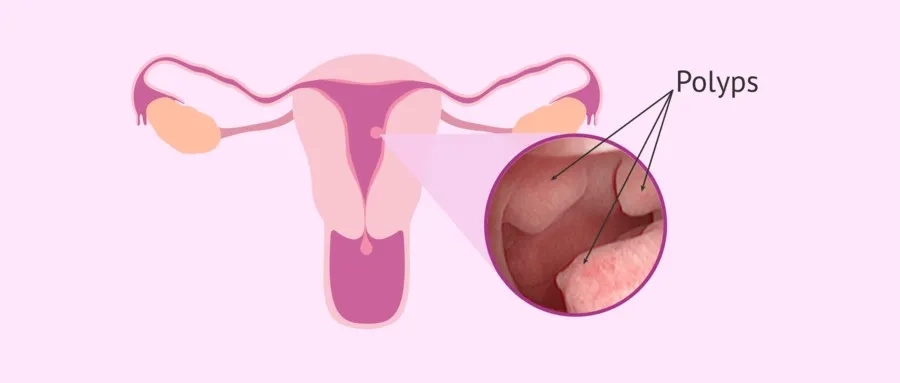 CHI PHÍ MỔ POLYP TỬ CUNG TẠI BỆNH VIỆN TỪ DŨ