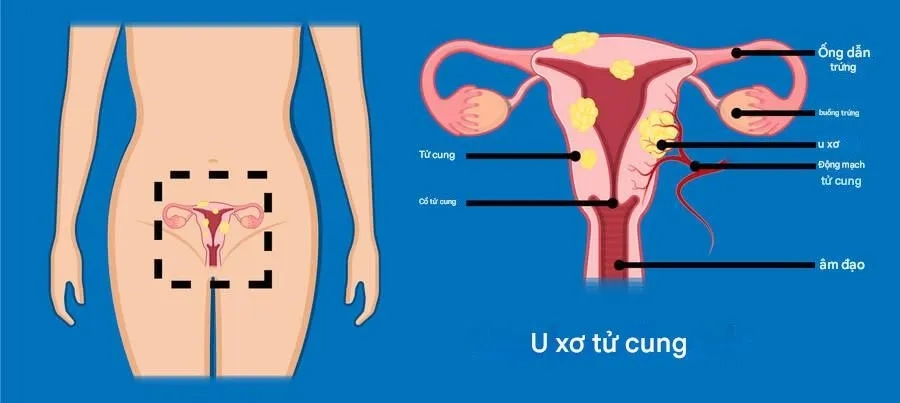 PHƯƠNG PHÁP LÀM THU NHỎ KHỐI U XƠ TỬ CUNG AN TOÀN HIỆU QUẢ
