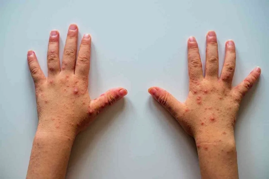 Triệu chứng tay chân miệng ở trẻ em: Khi nào nguy hiểm nên đi khám ngay?
