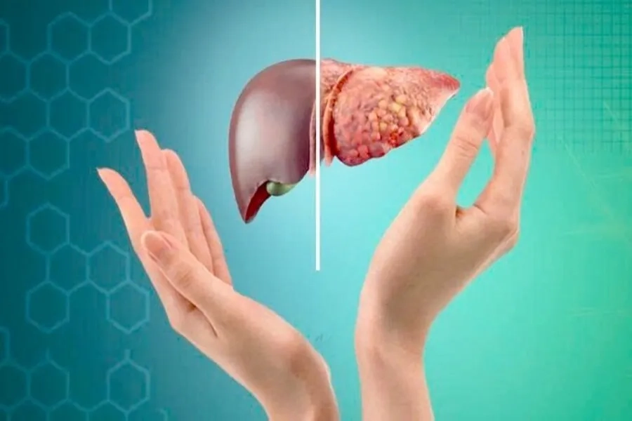 Gan Nhiễm Mỡ: Nguyên Nhân, Dấu Hiệu, Cách Điều Trị Theo Chuyên Gia