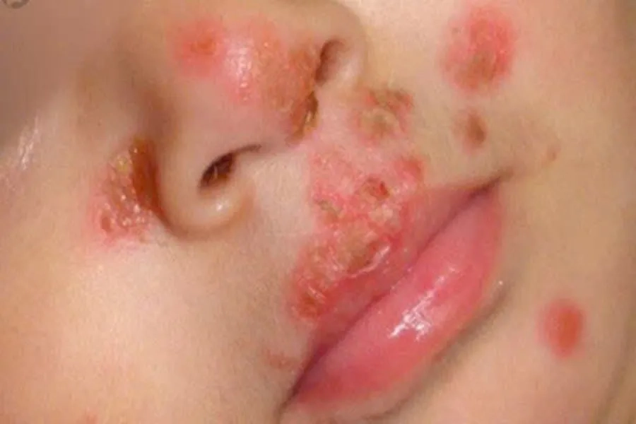 Viêm da mủ trẻ sơ sinh: Nguyên nhân, dấu hiệu, hướng điều trị và cách phòng ngừa