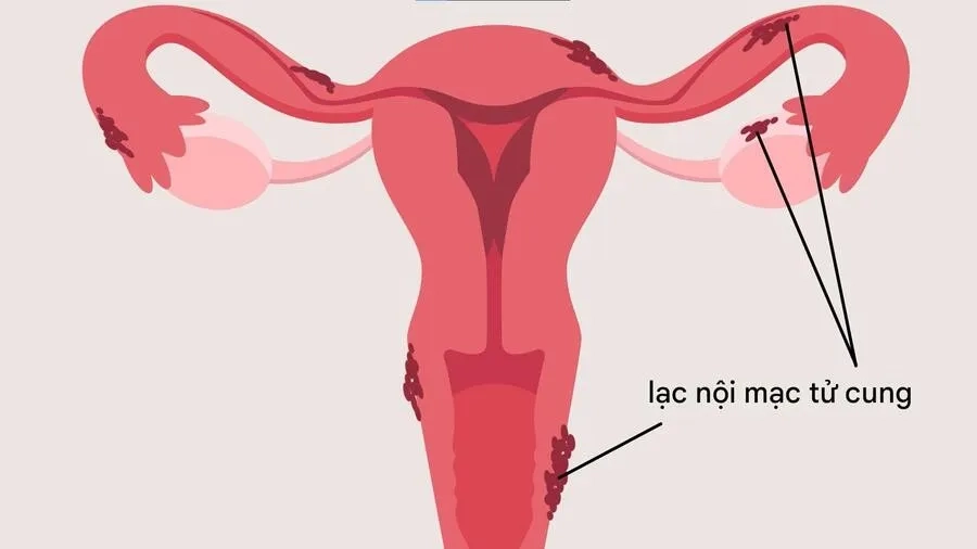 Lạc nội mạc tử cung: Nguyên nhân, triệu chứng, hướng điều trị và cách phòng ngừa hiệu quả