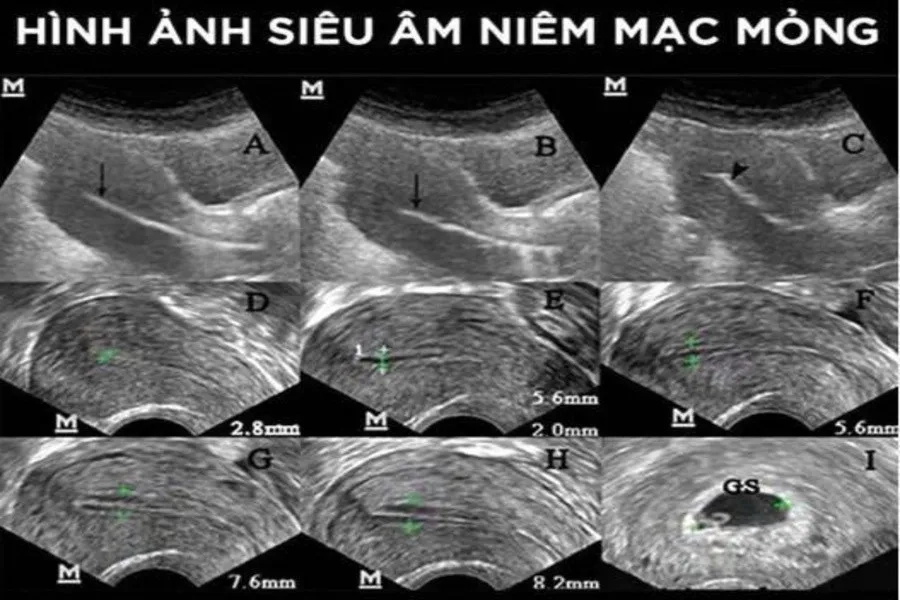 Niêm mạc tử cung mỏng: Nguyên nhân, dấu hiệu và hướng điều trị