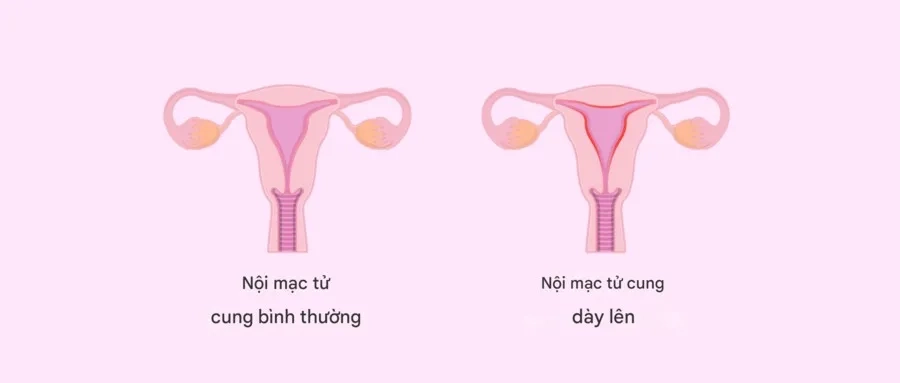 Nội mạc tử cung dày: Nguyên nhân, dấu hiệu và hướng điều trị 