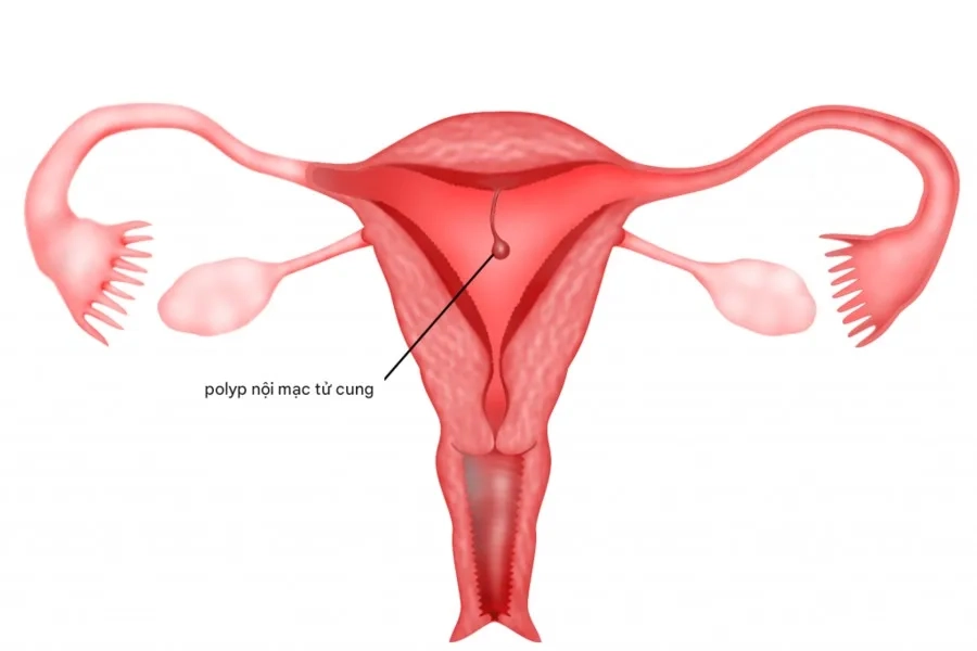 Polyp nội mạc tử cung: Nguyên nhân, triệu chứng, hướng điều trị và cách phòng ngừa hiệu quả