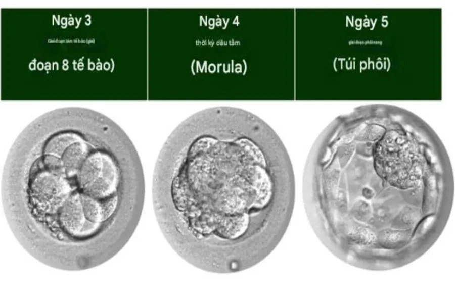 Tìm hiểu dấu hiệu chuyển phôi thành công theo từng ngày và bí quyết  tăng tỷ lệ đậu thai sau chuyển phôi