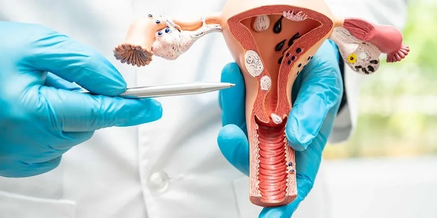 Nhân xơ tử cung khác gì với u xơ tử cung? Có phải là hai bệnh khác nhau không? 