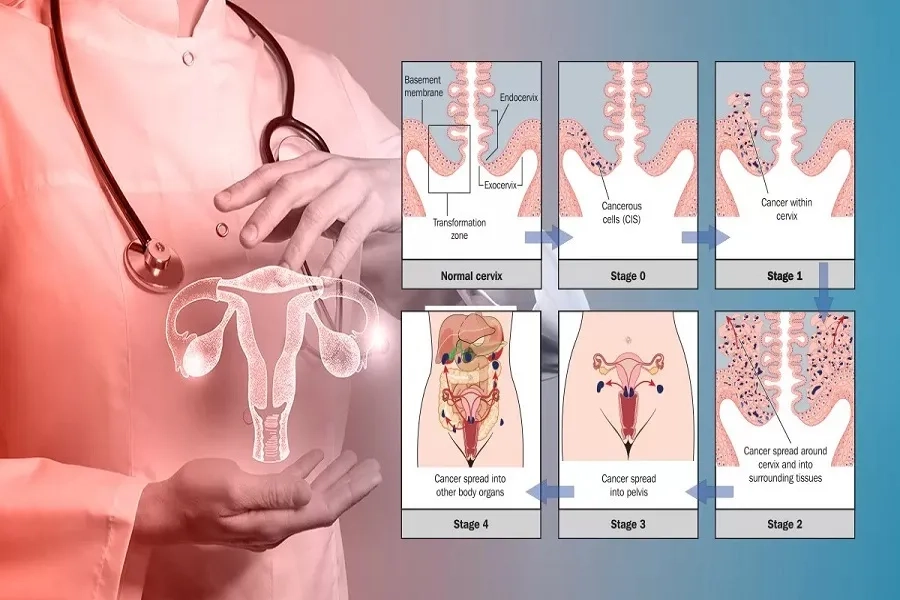 Các giai đoạn ung thư cổ tử cung: Dấu hiệu, tiên lượng và phương pháp điều trị