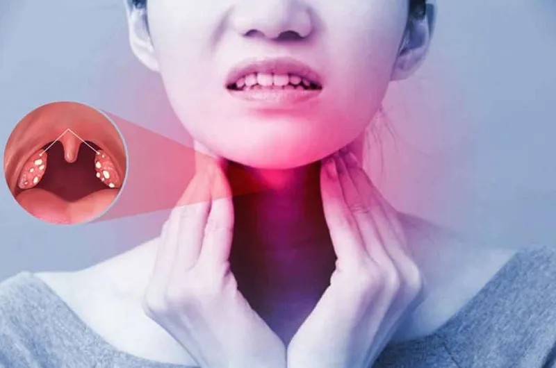 Viêm Amidan xơ teo là gì? Dấu hiệu, nguyên nhân, chẩn đoán, cách điều trị và phòng bệnh