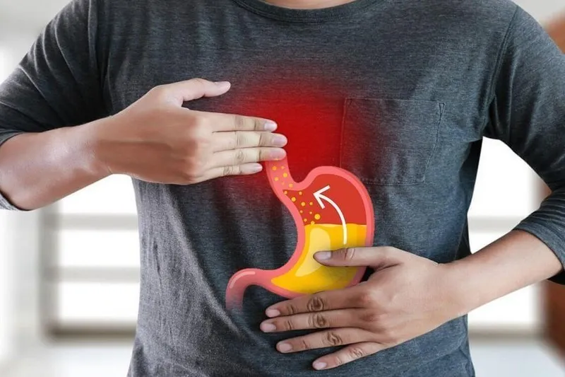Trào ngược dạ dày là gì? Dấu hiệu, nguyên nhân, chẩn đoán, cách điều trị và phòng bệnh