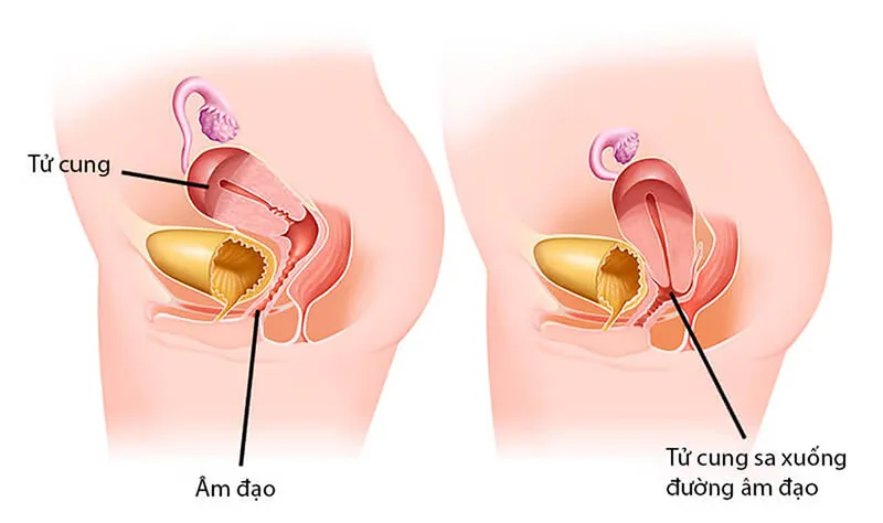 Sa tử cung sau sinh là gì? Triệu chứng, nguyên nhân và cách điều trị