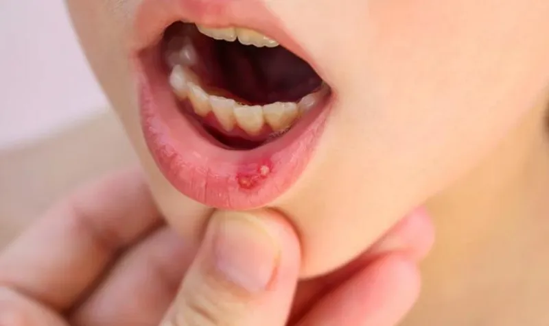 Viêm loét miệng là gì? Dấu hiệu, nguyên nhân, chẩn đoán, cách điều trị và phòng ngừa
