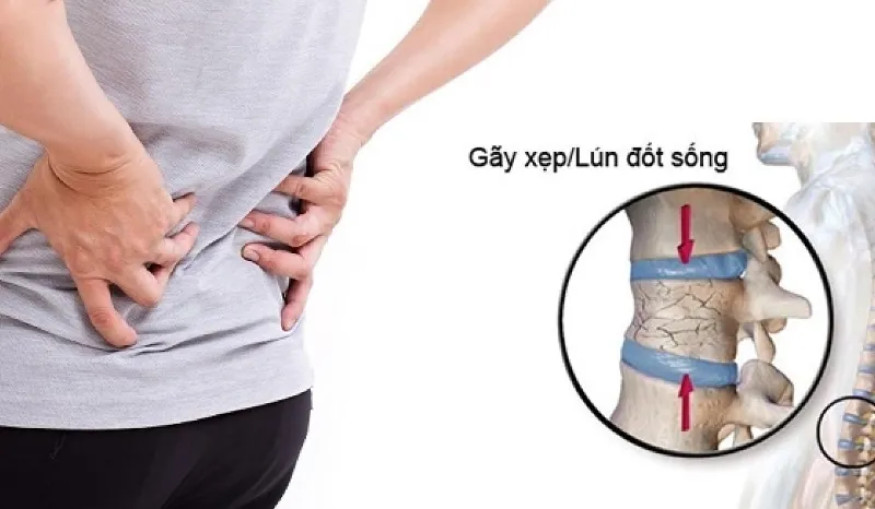 Xẹp đốt sống là gì? Dấu hiệu, nguyên nhân, chẩn đoán, cách điều trị và phòng bệnh