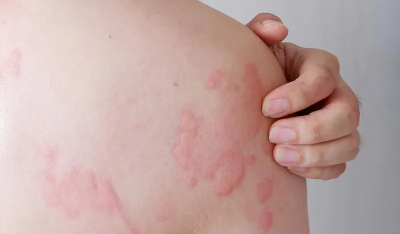 Dị ứng da là gì? Dấu hiệu, nguyên nhân, chẩn đoán, cách điều trị và phòng bệnh
