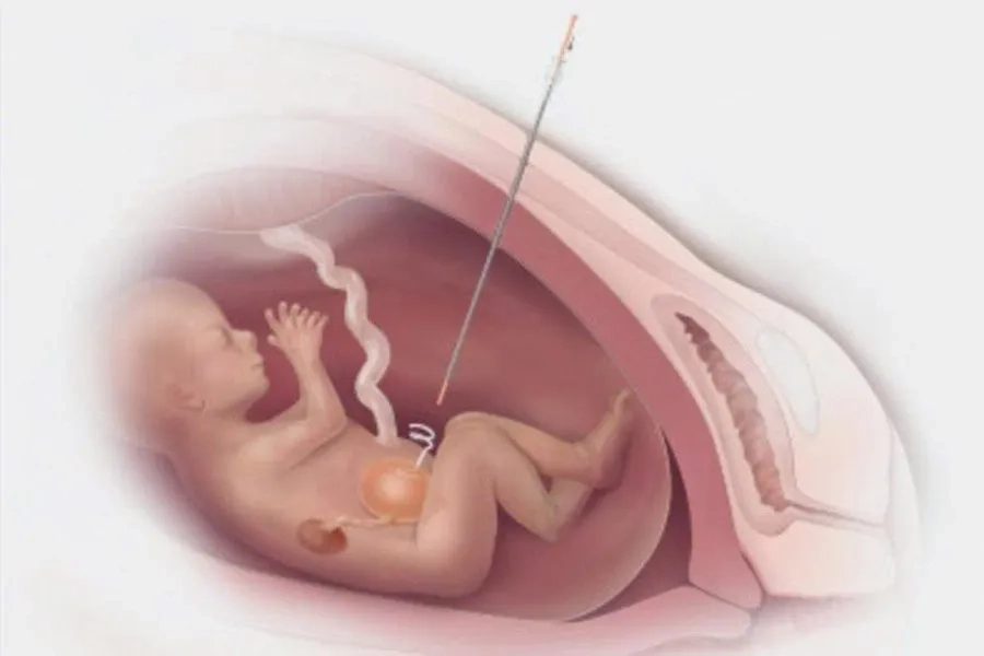 Kỹ Thuật Nội Soi Buồng Ối Dẫn Lưu Bàng Quang Thai Nhi Và Những Điều Cần Biết