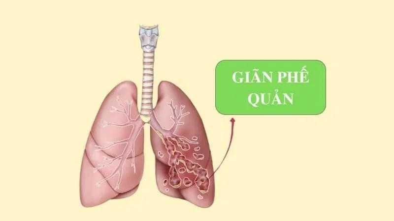 Giãn phế quản là gì? Dấu hiệu, nguyên nhân, chẩn đoán, cách điều trị và phòng bệnh