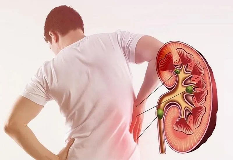 Cơn đau quặn thận là gì? Dấu hiệu, nguyên nhân, chẩn đoán, cách điều trị và phòng bệnh