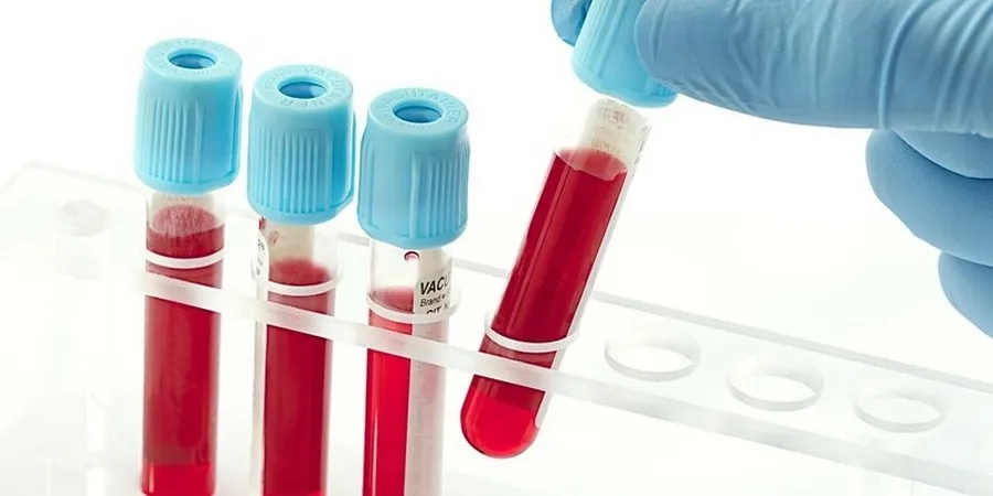 Làm Double Test khi nào? Lưu ý quan trọng khi thực hiện xét nghiệm mẹ bầu cần biết