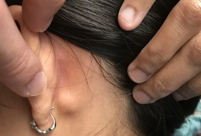  Trẻ bị nổi hạch sau gáy là gì? Dấu hiệu, nguyên nhân, chẩn đoán, cách điều trị và phòng bệnh