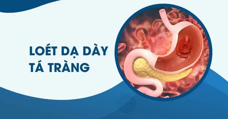 Loét dạ dày tá tràng là gì? Dấu hiệu, nguyên nhân, chẩn đoán, cách điều trị và phòng bệnh