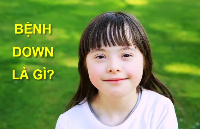 Bệnh Down là gì? Dấu hiệu, nguyên nhân, chẩn đoán, cách điều trị và phòng bệnh