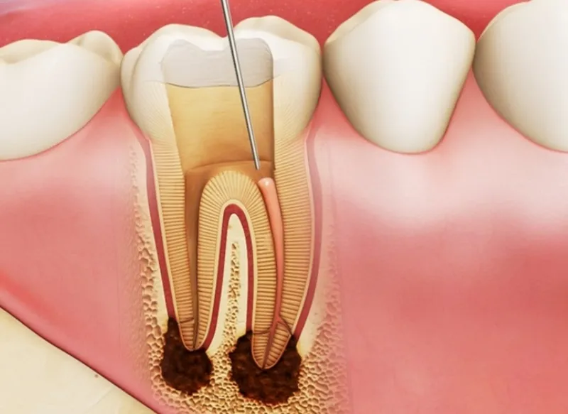 Viêm tủy răng là gì? Dấu hiệu, nguyên nhân, chẩn đoán, cách điều trị và phòng bệnh