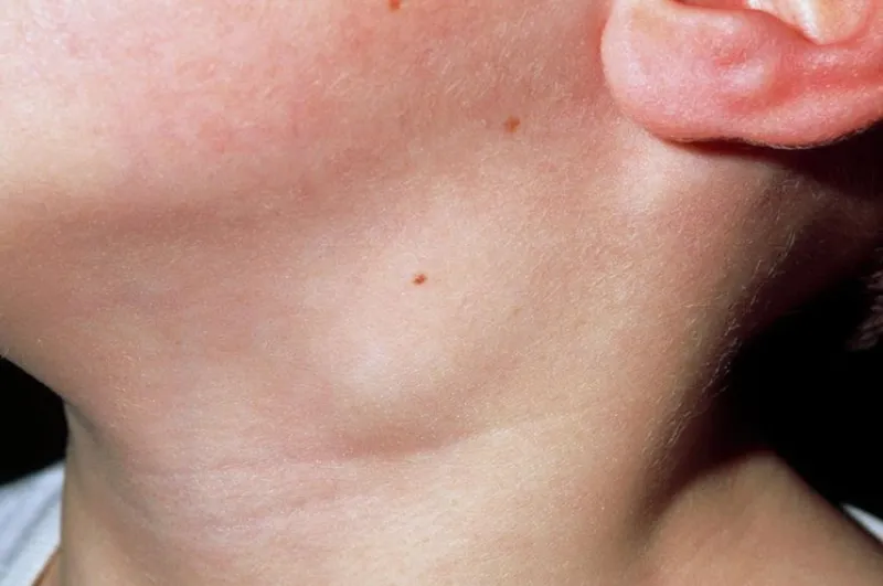 Viêm hạch cổ ở trẻ em là gì? Dấu hiệu, nguyên nhân, chẩn đoán, cách điều trị và phòng bệnh