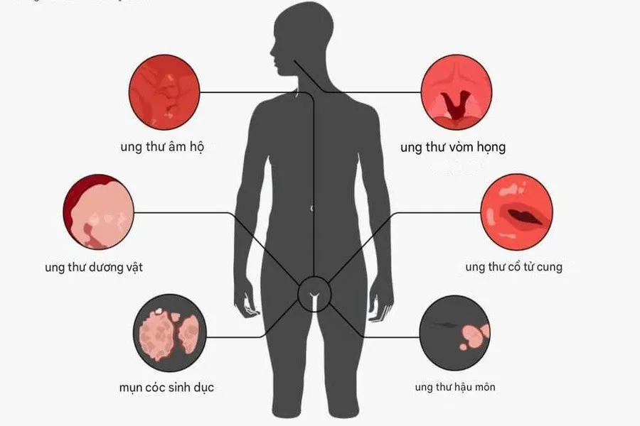 Dấu hiệu nhiễm HPV ở phụ nữ là gì? Chuyên gia gợi ý biện pháp phòng ngừa tốt nhất