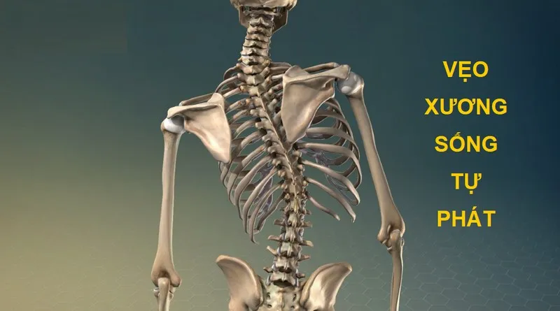  Vẹo xương sống tự phát là gì? Dấu hiệu, nguyên nhân, chẩn đoán, cách điều trị và phòng tránh