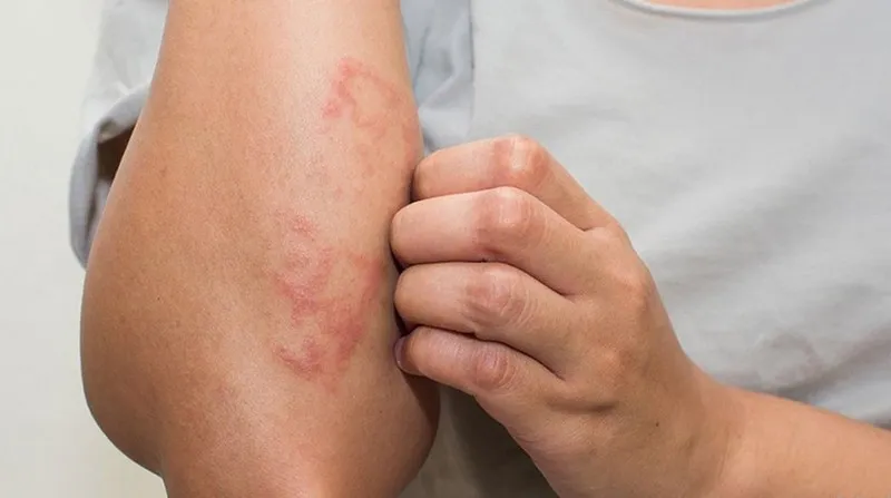  Ngứa da là gì? Dấu hiệu, nguyên nhân, chẩn đoán, cách điều trị và phòng tránh