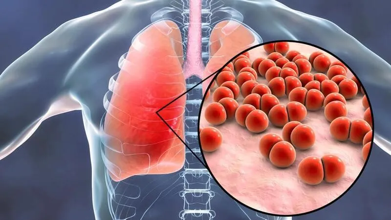 Phổi kẽ là gì? Dấu hiệu, nguyên nhân, chẩn đoán, cách điều trị và phòng bệnh