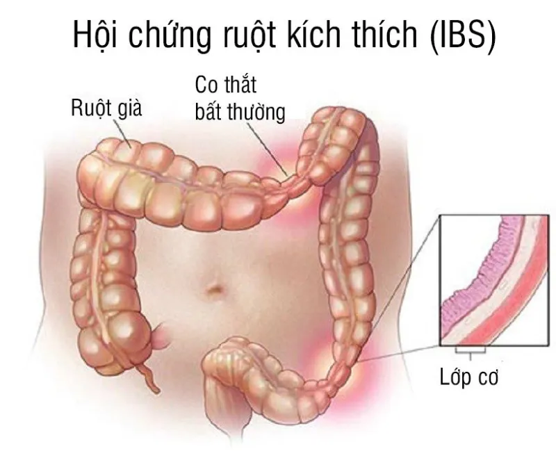 Hội chứng ruột kích thích là gì? Dấu hiệu, nguyên nhân, chẩn đoán, cách điều trị và phòng bệnh