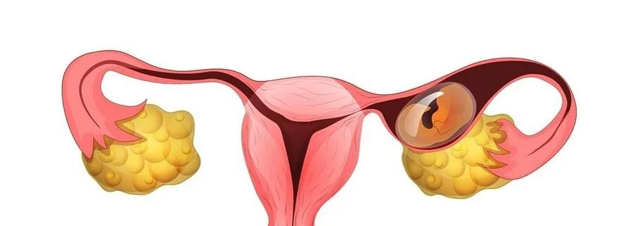 Nguyên nhân mang thai ngoài tử cung là gì? Cách phòng tránh và bảo vệ khả năng sinh sản