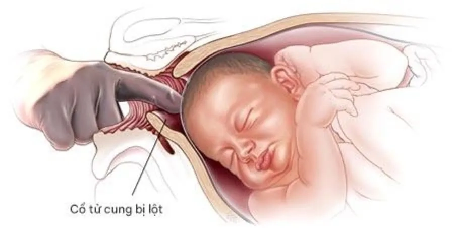 Lách ối là gì? Giải thích chi tiết cho mẹ bầu lần đầu mang thai