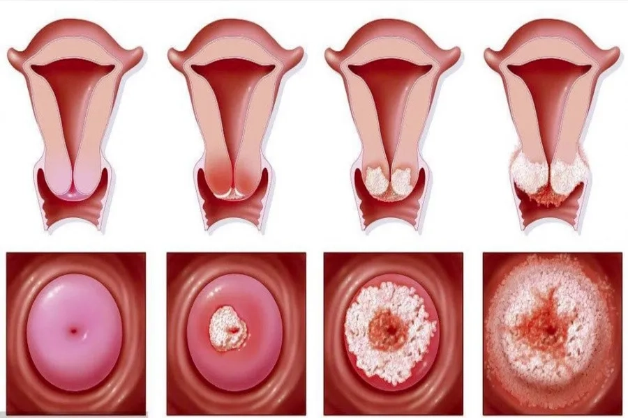 Dương tính với các type HPV nguy cơ cao có nguy hiểm không? Hướng dẫn cách phòng tránh