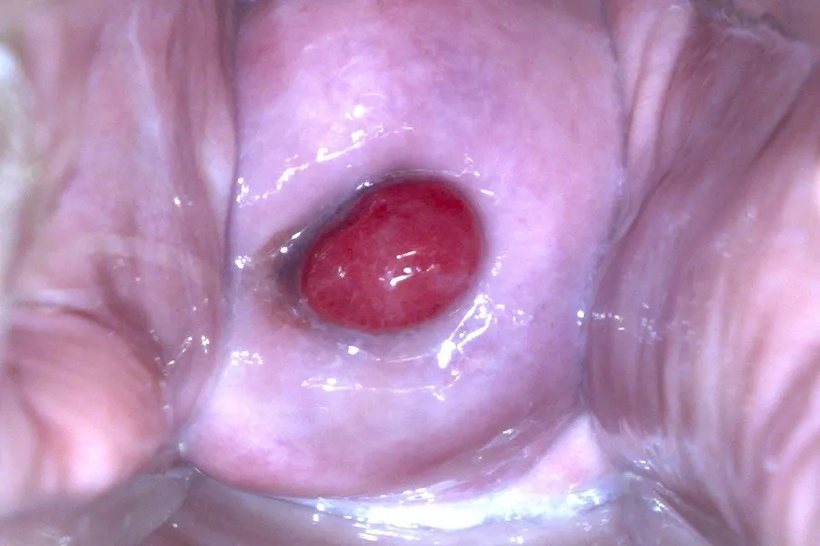 Polyp cổ tử cung có gây ung thư không? Nguyên nhân và cách điều trị