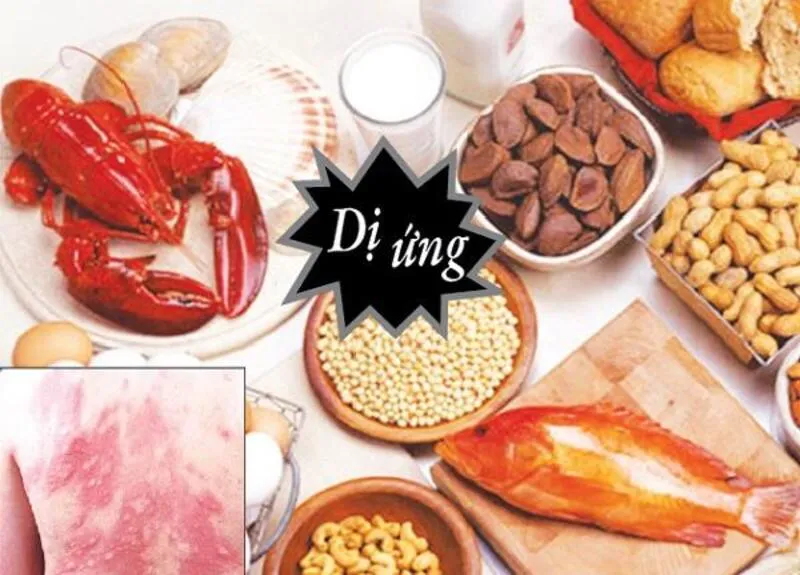 Dị ứng thực phẩm là gì? Dấu hiệu, nguyên nhân, chẩn đoán, cách điều trị và phòng bệnh                                                     