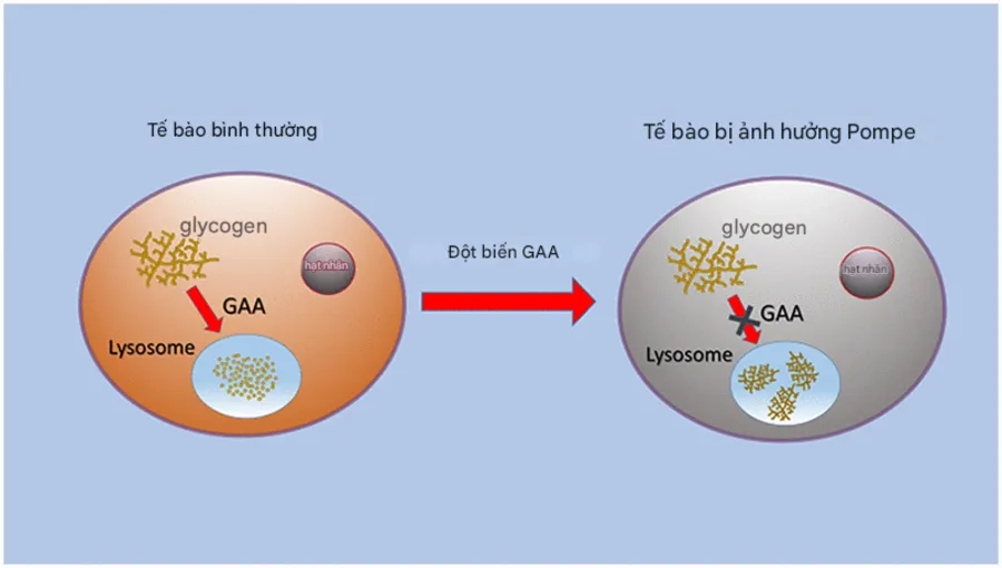 Bệnh Pompe là gì? Nguyên nhân, dấu hiệu và hướng điều trị hiệu quả