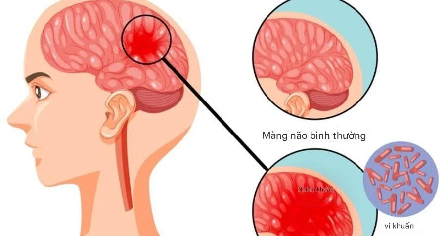 Viêm màng não mô cầu là gì? Nguyên nhân, triệu chứng và cách phòng ngừa hiệu quả
