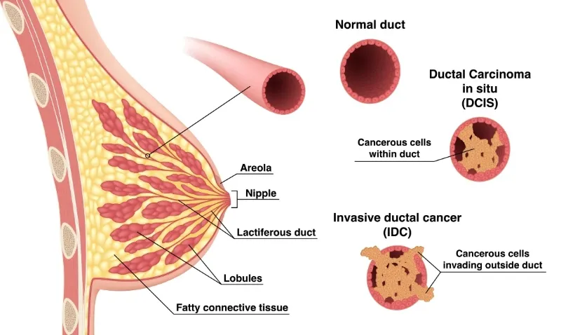 Carcinoma là ung thư gì?