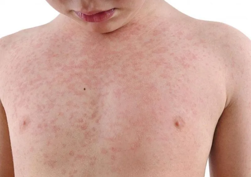 Trẻ phát ban sau sốt bao lâu thì khỏi?