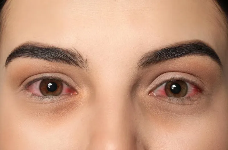 Bị đau mắt đỏ bao lâu thì khỏi?